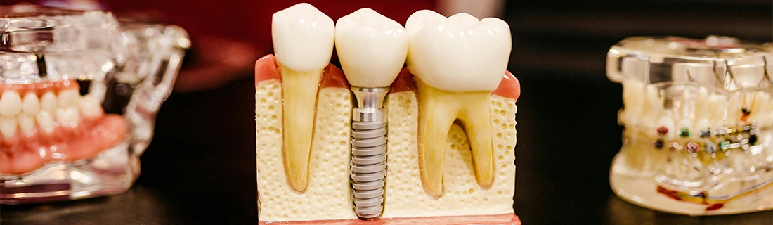 Dental Implants at John R. Striebel Dentistry in Miamisburg, OH – FC Dental Implants at John R. Striebel Dentistry in Miamisburg, OH – FC